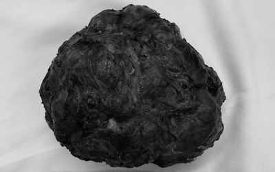 Cô gái trẻ 26 tuổi vòng một to bất thường, bác sĩ phát hiện bí mật bên trong