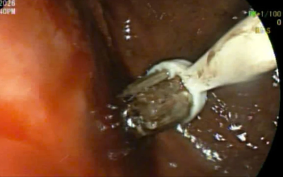 Nam thanh niên 29 tuổi đau bụng, bác sĩ lấy ra thứ "đáng sợ" trong cơ thể