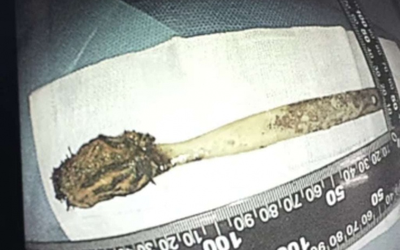 Đau bụng đi khám, người đàn ông "sốc" phát hiện bàn chải nằm trong bụng 52 năm