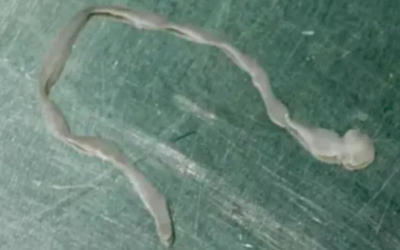 Người phụ nữ lên cơn co giật, bác sĩ lấy ra thứ đáng sợ trong não