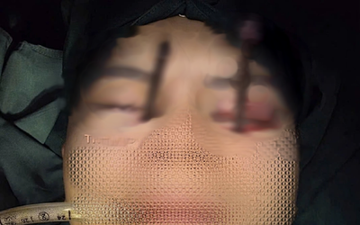 Chàng trai 25 tuổi đau mắt dữ dội, bác sĩ phát hiện bí mật "đáng sợ"