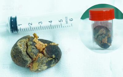 Đi khám sức khỏe định kỳ, người phụ nữ "sốc" khi phát hiện điều bất ngờ