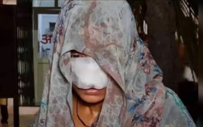 Cãi nhau, chồng cắn vào mũi và má khiến vợ phải khâu 10 mũi