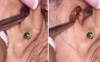 Người phụ nữ đau tai đi khám, bác sĩ gắp ra thứ "đáng sợ"