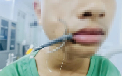 Bé trai 15 tuổi đau dữ dội vùng má, bác sĩ lấy ra thứ "đáng sợ" bên trong