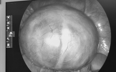 Đau bụng tưởng nhẹ, người phụ nữ sốc nặng khi bác sĩ lấy ra thứ “rợn người” trong cơ thể