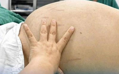 Thiếu nữ 19 tuổi bụng to như bầu, bác sĩ phát hiện bí mật "đáng sợ" bên trong