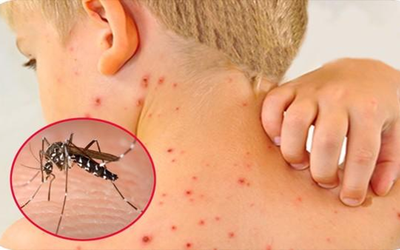 Dịch sốt xuất huyết tăng cao, chuyên gia cảnh báo biến chứng nặng của bệnh