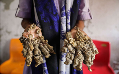 Dị nhân với đôi tay mọc như rễ cây: Căn bệnh hiếm với 25 ca phẫu thuật gây ám ảnh