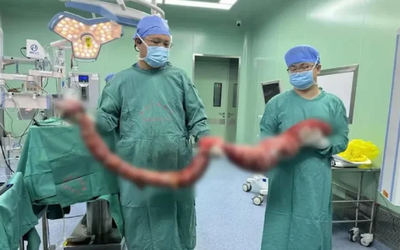 Người đàn ông 4 tháng không đi đại tiện, bụng phình to như "mang thai", bác sĩ lấy ra thứ "đáng sợ"