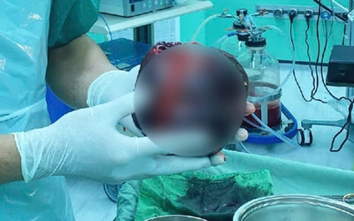 Đau bụng tưởng nhẹ, người đàn ông "sốc nặng" khi phát hiện thứ "đáng sợ" to bằng quả dưa lưới