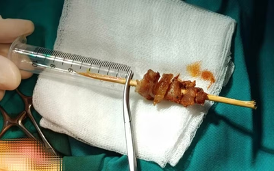 Bé 2 tuổi gặp sự cố nguy hiểm với que xiên thịt trong lúc chạy nhảy