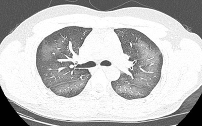 Người phụ nữ "phổi trắng xóa", bác sĩ tiết lộ thủ phạm quen mặt khiến ai nghe cũng "lạnh gáy"