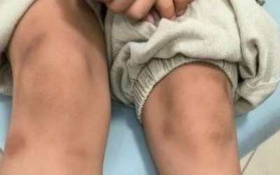 Ăn thịt nướng cuốn xà lách, bé trai 6 tuổi nổi đầy vết bầm tím "bất thường"