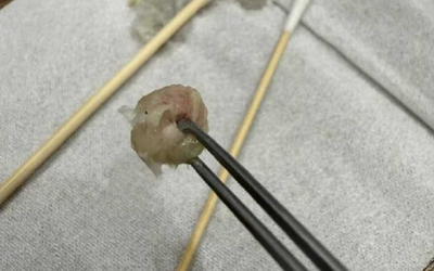 Bé gái 6 tuổi nhập viện khẩn cấp, bố mẹ "sốc" khi bác sĩ lấy ra thứ "đáng sợ" từ mũi con