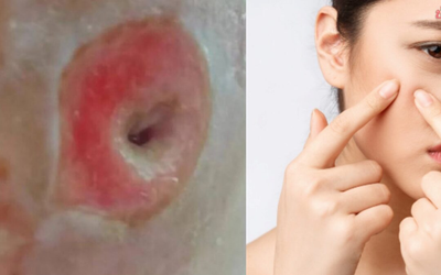 Người phụ nữ 40 tuổi chết lặng khi thấy mặt như "tổ ong" vì sai lầm ai cũng dễ mắc