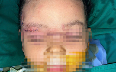 Bé 22 tháng tuổi bị chó cắn: Bác sĩ xử trí nhanh, hạn chế biến chứng