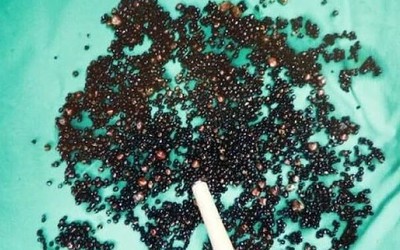 Đau bụng suốt nhiều tháng, người đàn ông 43 tuổi sốc nặng khi bác sĩ gắp ra thứ "đáng sợ" trong bụng