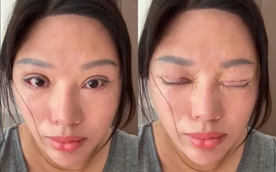 Người phụ nữ 6 năm không thể nhắm mắt khi ngủ, lý do phía sau khiến nhiều người bất ngờ