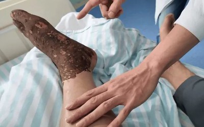 Bị rắn độc cắn khi đang cấy lúa, người đàn ông làm 1 việc khiến bác sĩ khen ngợi