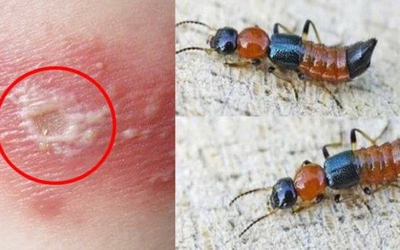 Những sai lầm phổ biến khi nhầm viêm da do kiến ba khoang với bệnh zona thần kinh