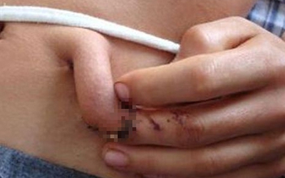 Người đàn ông 20 tuổi có ngón tay "mọc" ra từ ổ bụng, sự thật phía sau gây bất ngờ