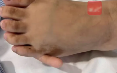 Cô gái 17 tuổi có 6 ngón tay "mọc" ra và sự thật bất ngờ