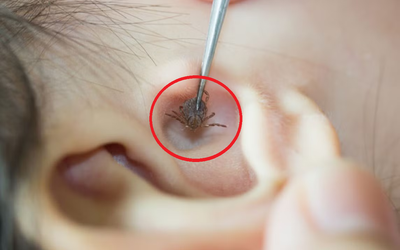Bé 2 tuổi đau tai bất thường, bố mẹ "sốc" khi bác sĩ gắp ra thứ "đáng sợ" bên trong