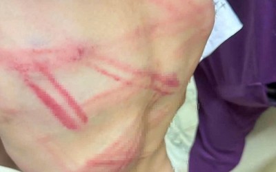 Bố đánh con trai 9 tuổi nhập viện với nhiều vết bầm tím, lý do gây bức xúc