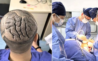 Người đàn ông 23 tuổi có da đầu dày, gấp nếp như bộ não và sự thật bất ngờ