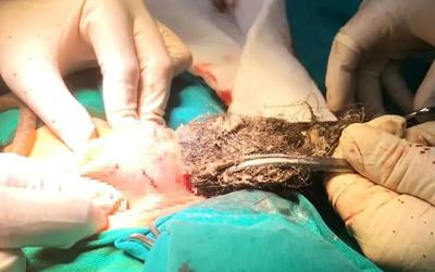 Phẫu thuật lấy búi tóc dài gần 20cm trong dạ dày bé trai 4 tuổi, do bé mắc bệnh lạ