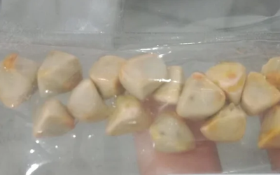 Uống trà đá đều đặn suốt 10 năm, người phụ nữ sốc khi bác sĩ lấy ra thứ "đáng sợ" trong bụng