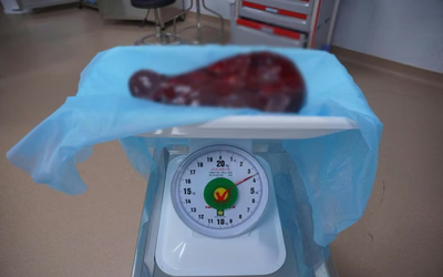 Bụng người đàn ông 69 tuổi ngày càng phình to, bác sĩ sững sờ khi phát hiện thứ "khổng lồ" bên trong
