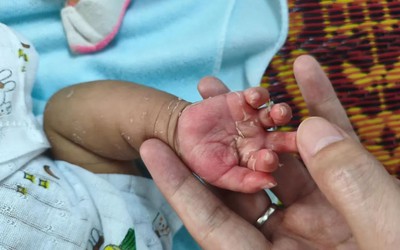 Xuất hiện dấu hiệu lạ ở da, bé 2 tháng tuổi mắc bệnh ít ai ngờ
