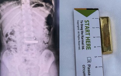 Bé gái 5 tuổi nuốt thỏi vàng dài 4cm vào bụng