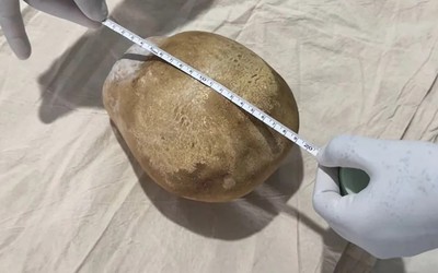Lấy viên sỏi nặng 3,1kg ra khỏi bàng quang của người đàn ông 55 tuổi