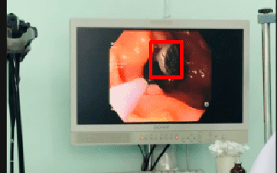 Ngậm đinh trong miệng, người đàn ông 50 tuổi gặp sự cố đáng sợ