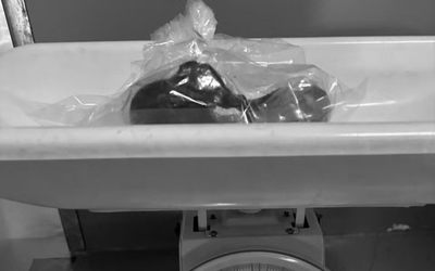 Bé gái 5 tuổi biểu hiện lạ, bác sĩ gắp ra thứ "đáng sợ" trong bụng