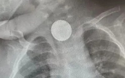 Bé gái hơn 1 tuổi cứ ăn là nôn, bố mẹ sốc khi biết sự thật