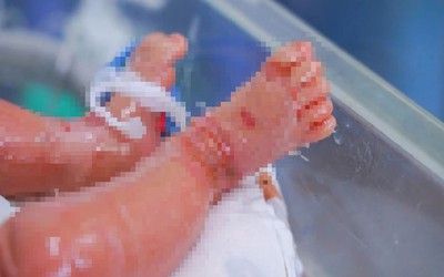Bé trai sinh non mắc bệnh vảy cá hiếm gặp
