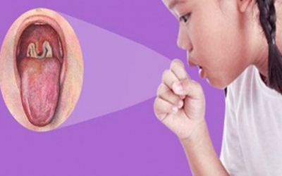 Mắc bệnh bạch hầu có thể khiến bệnh nhân tử vong trong vòng 6-10 ngày