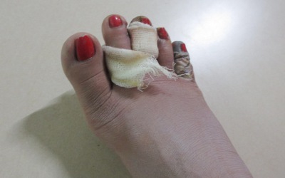Người vợ bị chồng chích điện suýt chết đã bị cắt bỏ 2 ngón chân