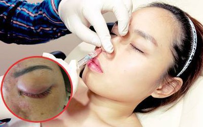 Điểm mặt hàng loạt những vụ tiêm filler dẫn đến mù mắt, hoại tử