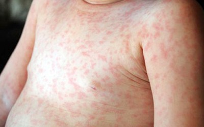 Sởi, rubella vào mùa, làm gì để con bạn không mắc bệnh?