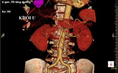 Chàng trai 28 tuổi ung thư gan sau hơn 10 năm làm điều mà hầu như thanh niên nào cũng mắc phải