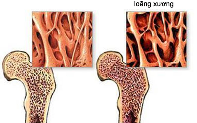 Những biến chứng nguy hiểm do bệnh loãng xương gây ra