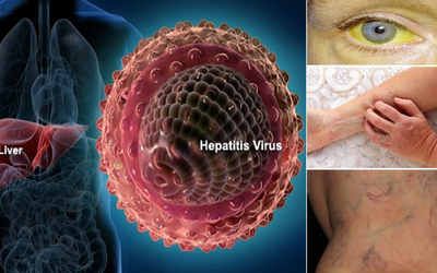 Chuyện của hàng triệu giấc mơ bị virus viêm gan B đánh cắp