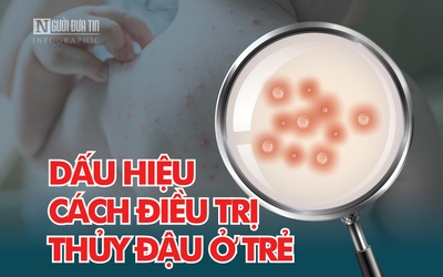 Info: Dấu hiệu và cách điều trị thủy đậu ở trẻ