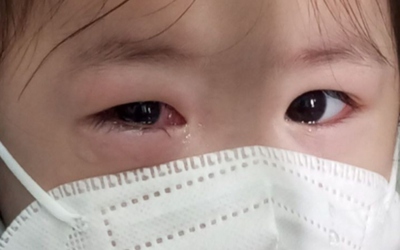 Bệnh đau mắt đỏ gia tăng, Bộ Y tế yêu cầu tăng cường giám sát