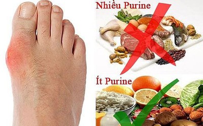 7 thực phẩm mà người mắc bệnh gout nên tránh xa